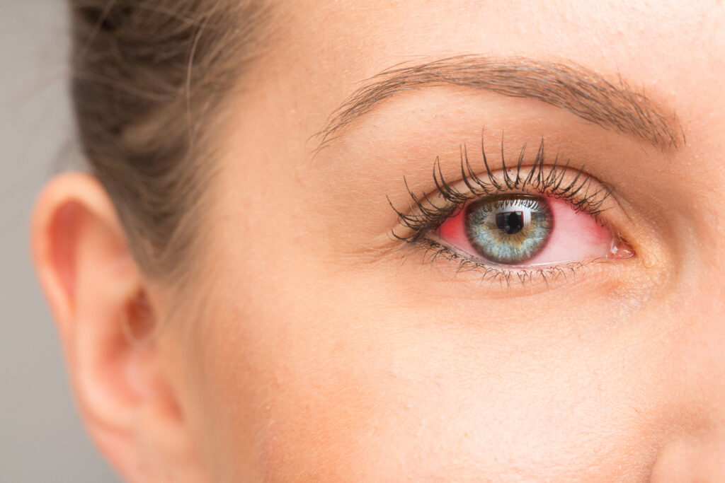 Woman’s eye with a red, inflamed sclera.