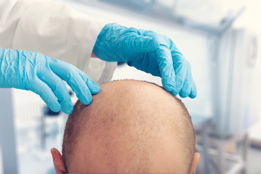 Man with pattern baldness being assessed by doctor with gloves on