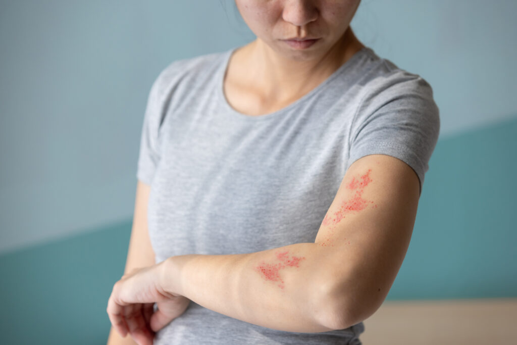 Hives: Causes, Symptoms, Diagnosis, Treatment & Prevention