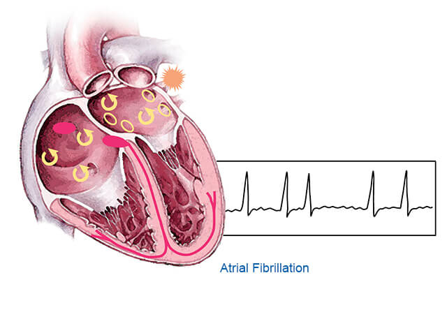 Atrial fibrillation